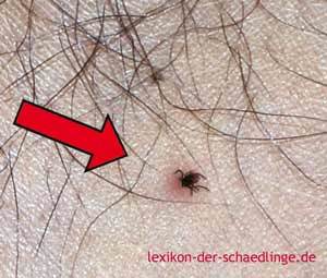 Zeckenbisse Bilder: Zecke am Bein Holzbock Ixodes Ricinus an Bein Mann