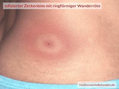 Borreliose Wanderröte Ring